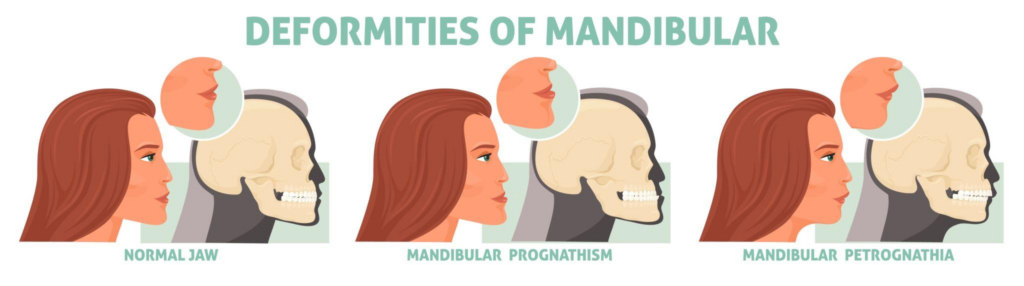 Medical illustration of mandibular prognathism compared with a classical royal portrait showing prominent lower jaw structure.